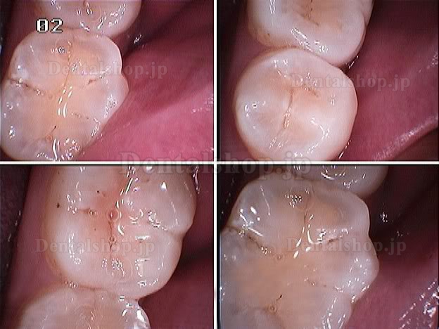 口腔内カメラ MD740 USB接続|口腔内カメラ通販-Dentalshop.JP